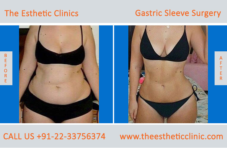 Gastric Sleeve Surgery, bariatric surgery before after photos in mumbai india (1)